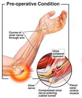 Cubital tunnel syndrome (ulnar nerve compression neuropathy)