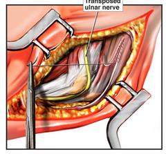 Potential sites of ulnar nerve compression in cubital tunnel